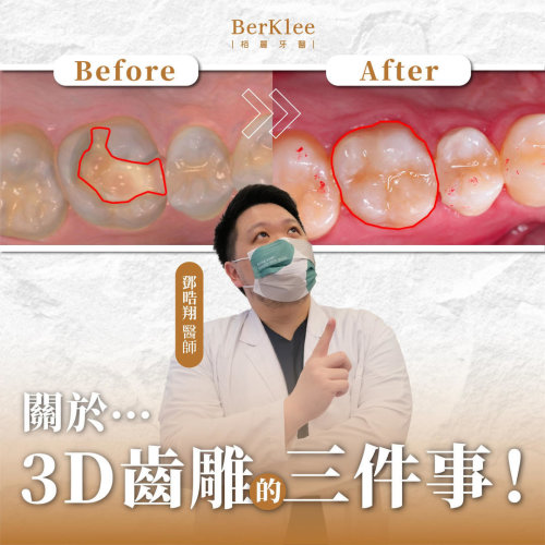3D 齒雕｜蛀牙需要補牙怎麼辦？你需要更美觀的解決方式！